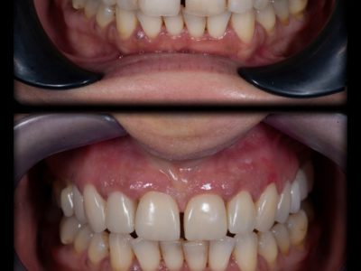 Импланти, Салиев Дентал Кеър, Бондинг, Dental clinic Sofia