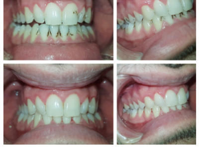 Импланти, Салиев Дентал Кеър, Бондинг, Dental clinic Sofia