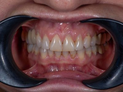Импланти, Салиев Дентал Кеър, Бондинг, Dental clinic Sofia