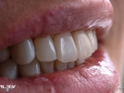 Импланти, Салиев Дентал Кеър, Бондинг, Dental clinic Sofia