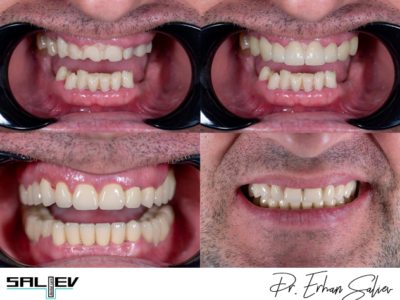 Импланти, Салиев Дентал Кеър, Бондинг, Dental clinic Sofia