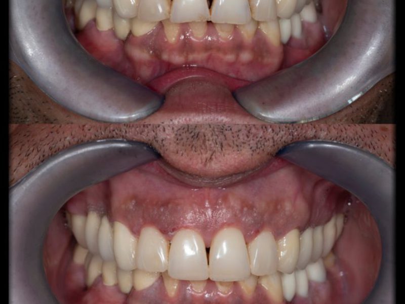 bonding saliev dental care