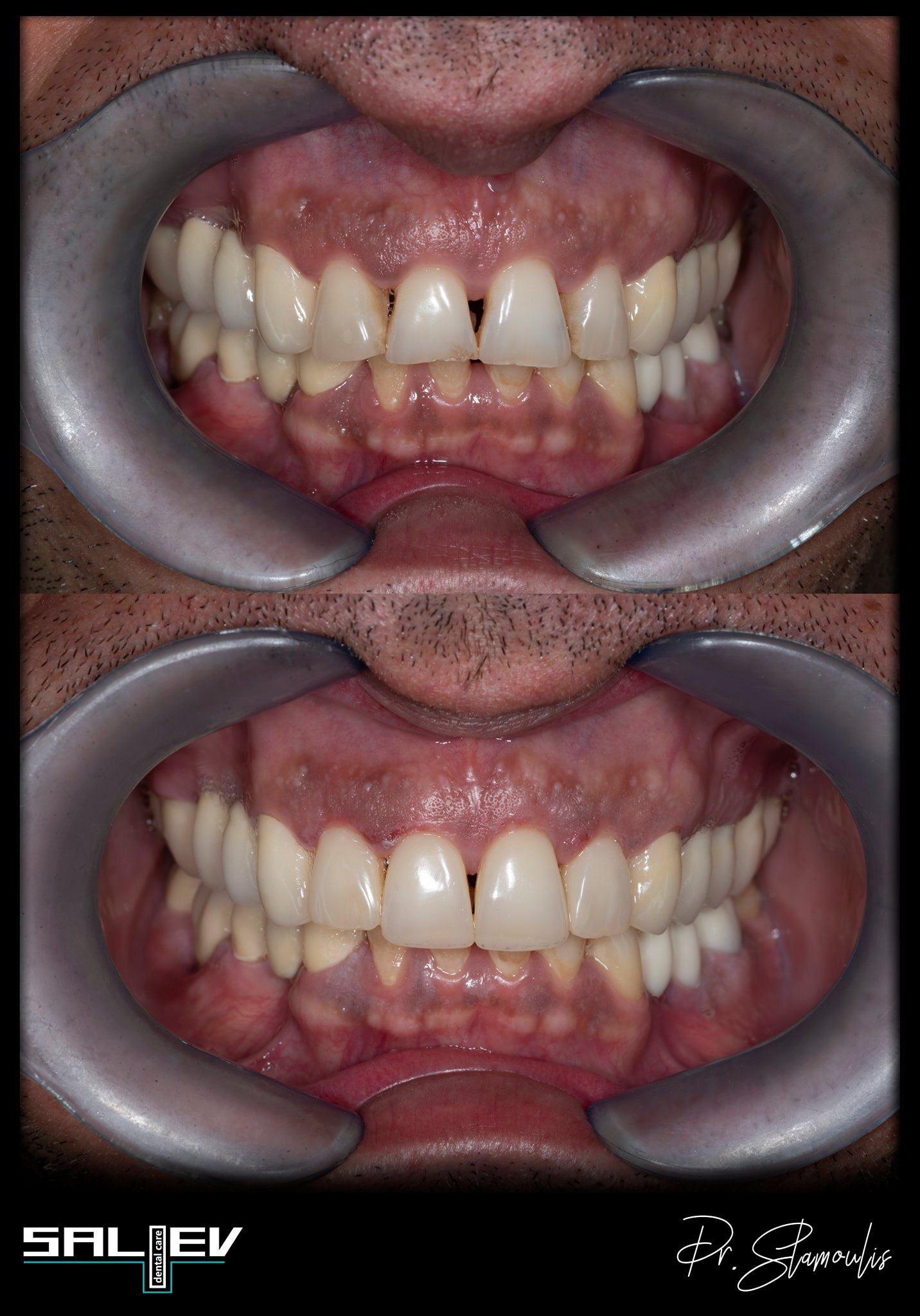 bonding saliev dental care
