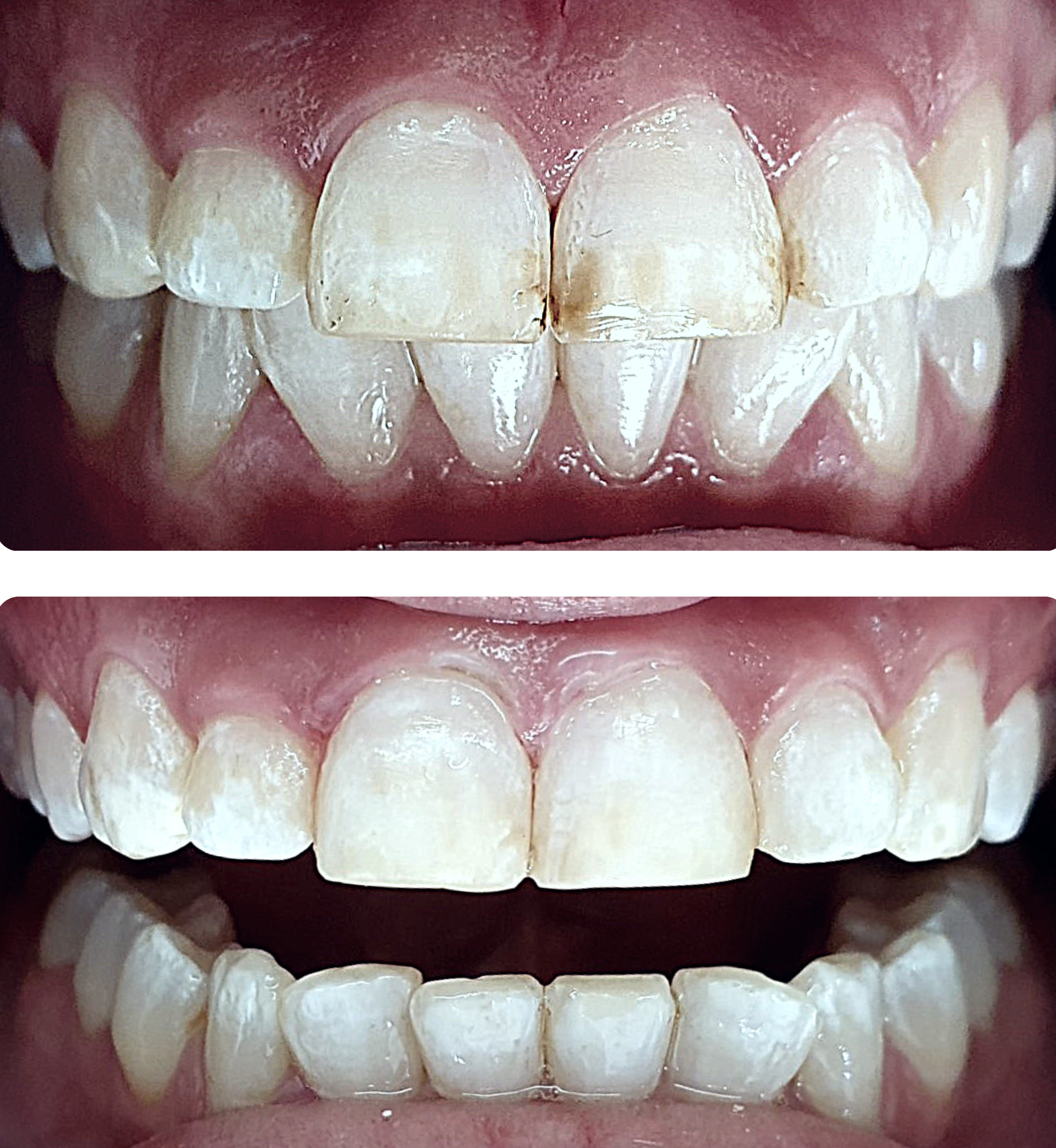Лечение на флуороза, д-р Каролина Бачова, Saliev Dental Care София