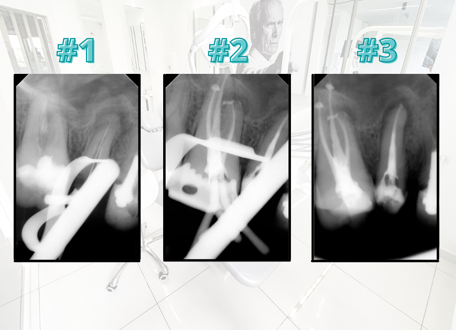 Периодонтити, преди и след лечението, д-р Каролина Бачова, Saliev Dental Care София