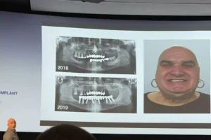 Рентгенови снимки на зъбни импланти от 2018 и 2019 година, показващи напредък.