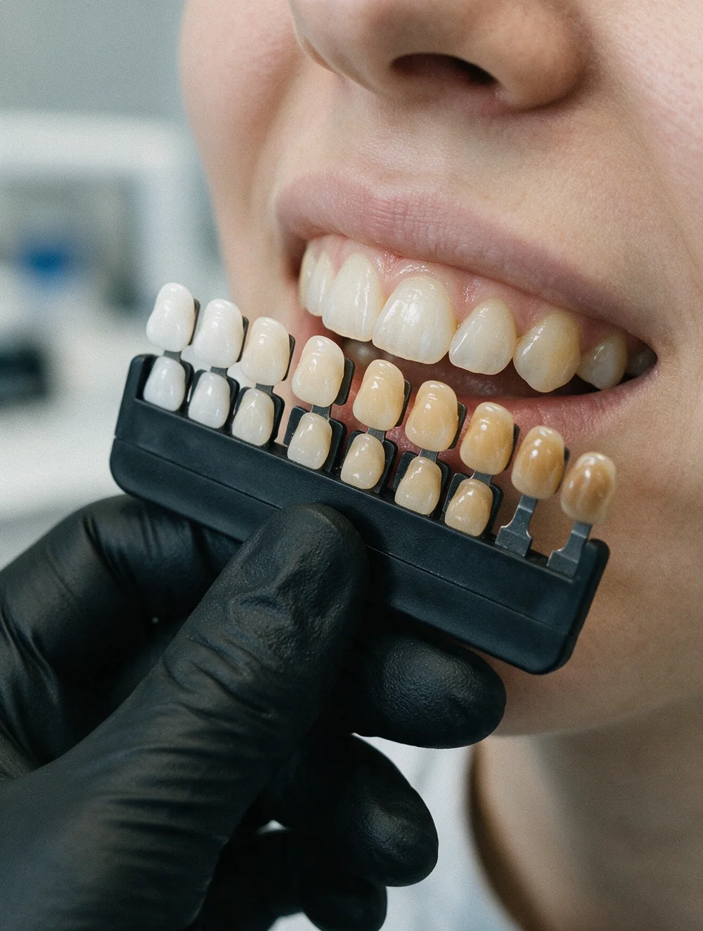 Избор на цвят на композита с разцветка при бондинг, Saliev Dental Care София