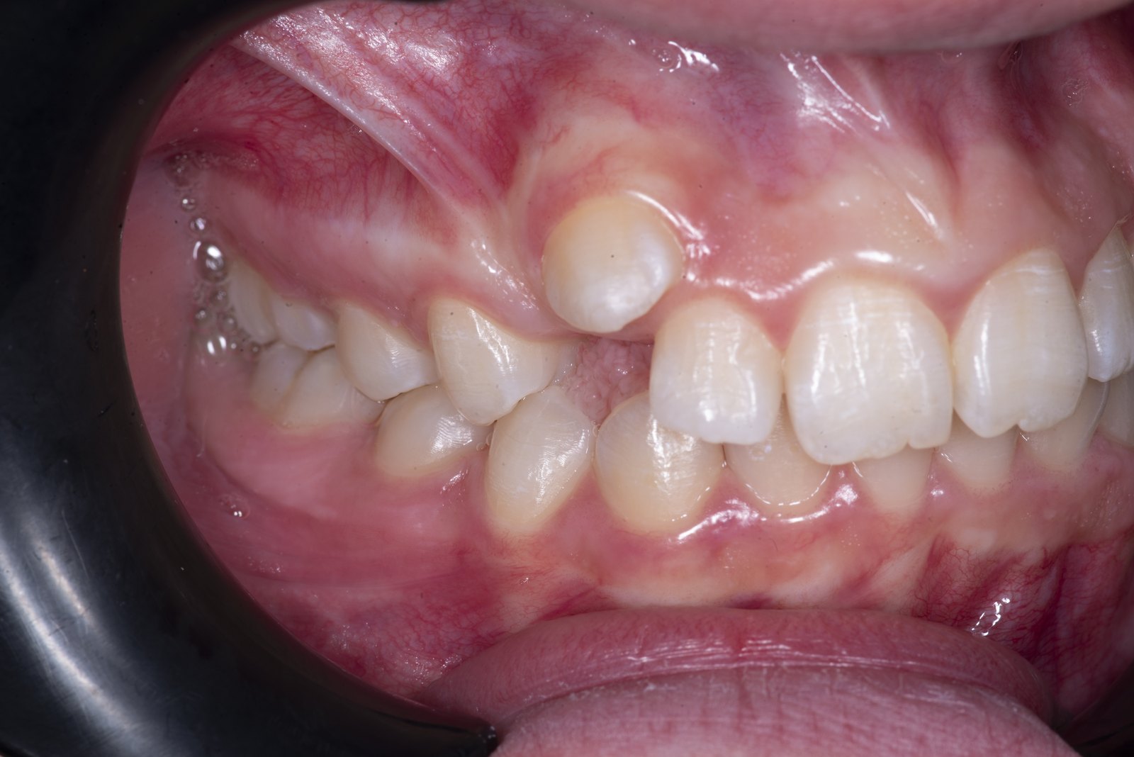 Случай 1, преди ортодонтско лечение: фронтален изглед – Saliev Dental Care, София