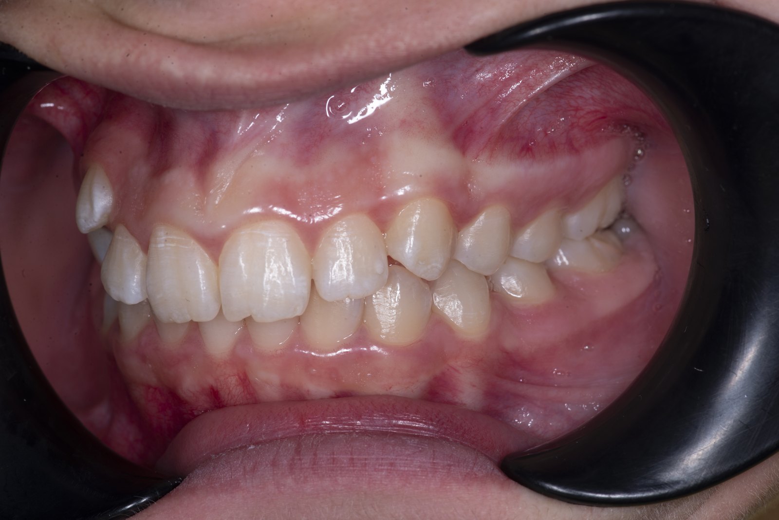 Случай 1, преди ортодонтско лечение: страничен изглед, ляво – Saliev Dental Care, София