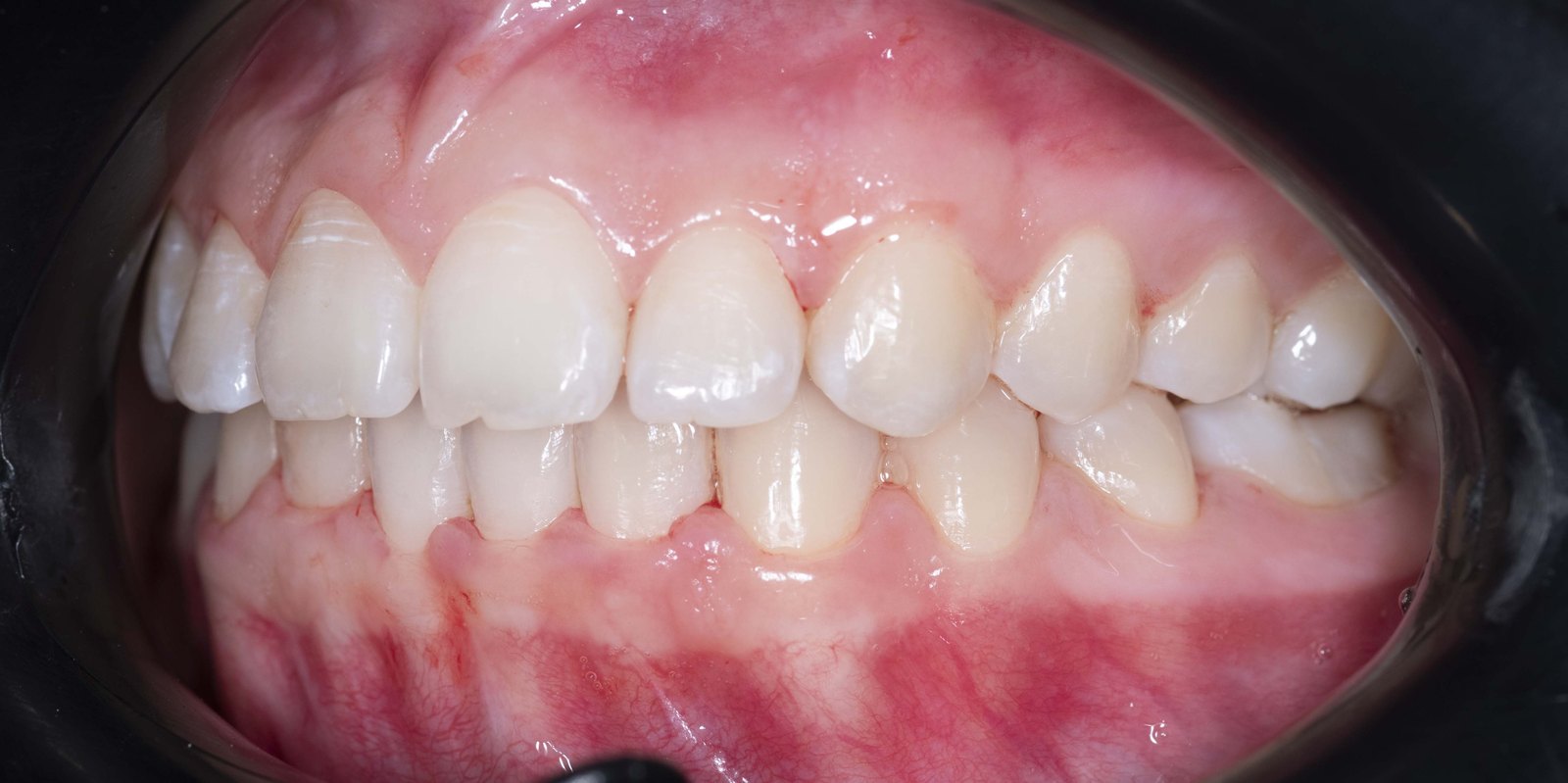 Случай 1, след ортодонтско лечение: страничен изглед, дясно – Saliev Dental Care, София