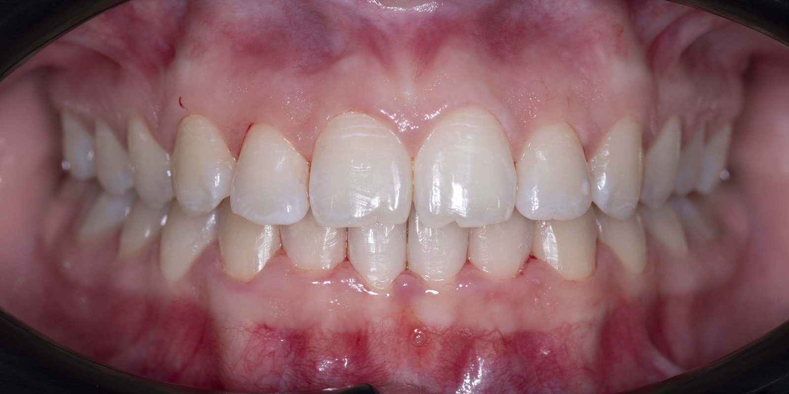 Случай 1, след ортодонтско лечение: фронтален изглед – Saliev Dental Care, София