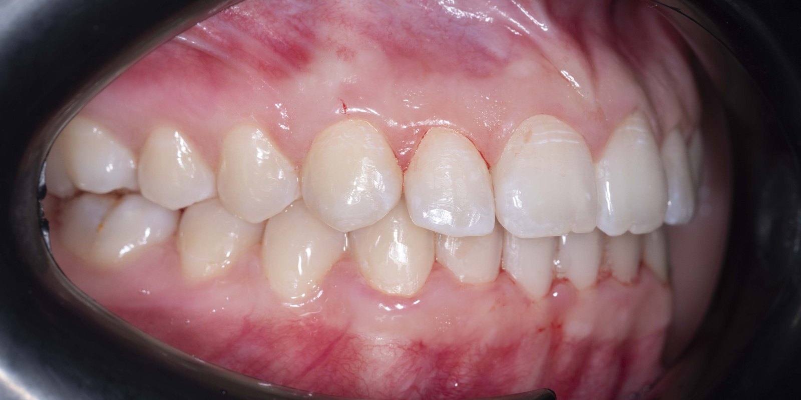 Случай 1, след ортодонтско лечение: страничен изглед, ляво – Saliev Dental Care, София