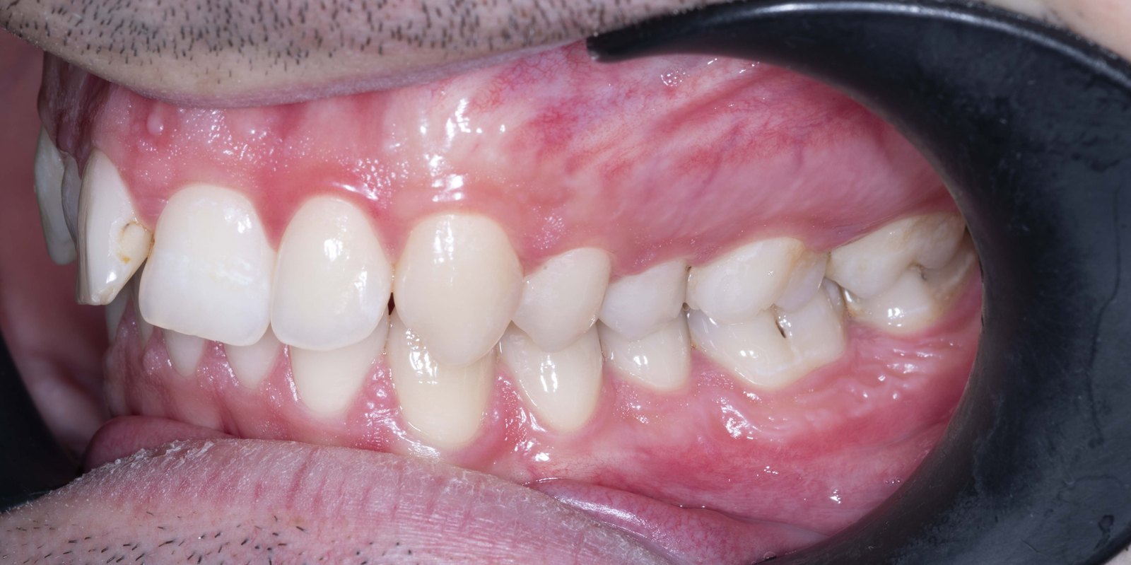 Случай 2, преди ортодонтско лечение: страничен изглед, дясно – Saliev Dental Care, София