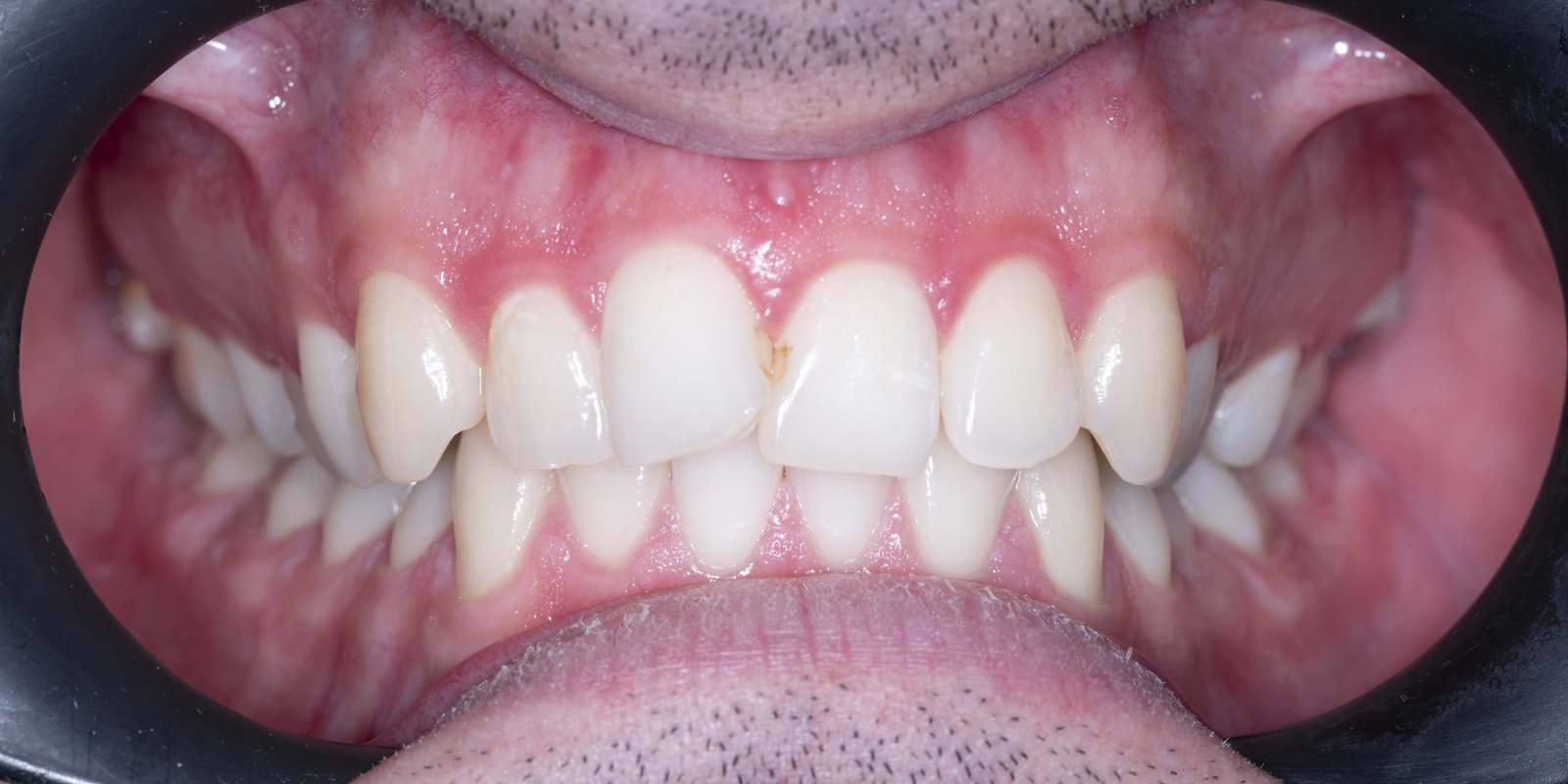 Случай 2, преди ортодонтско лечение: фронтален изглед – Saliev Dental Care, София