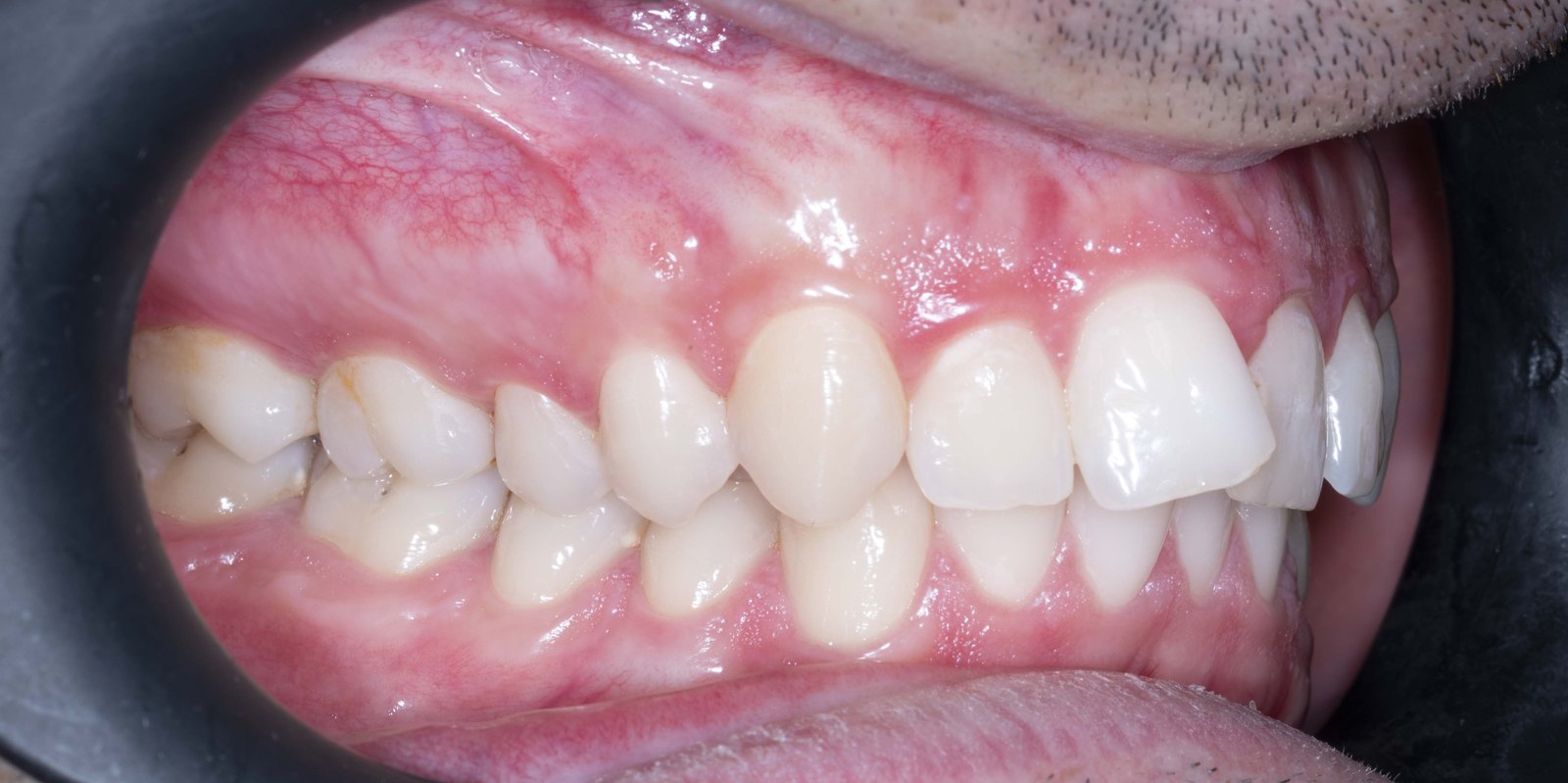 Случай 2, преди ортодонтско лечение: страничен изглед, ляво – Saliev Dental Care, София