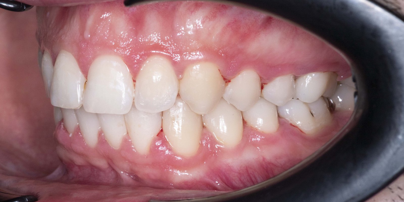 Случай 2, след ортодонтско лечение: страничен изглед, дясно – Saliev Dental Care, София