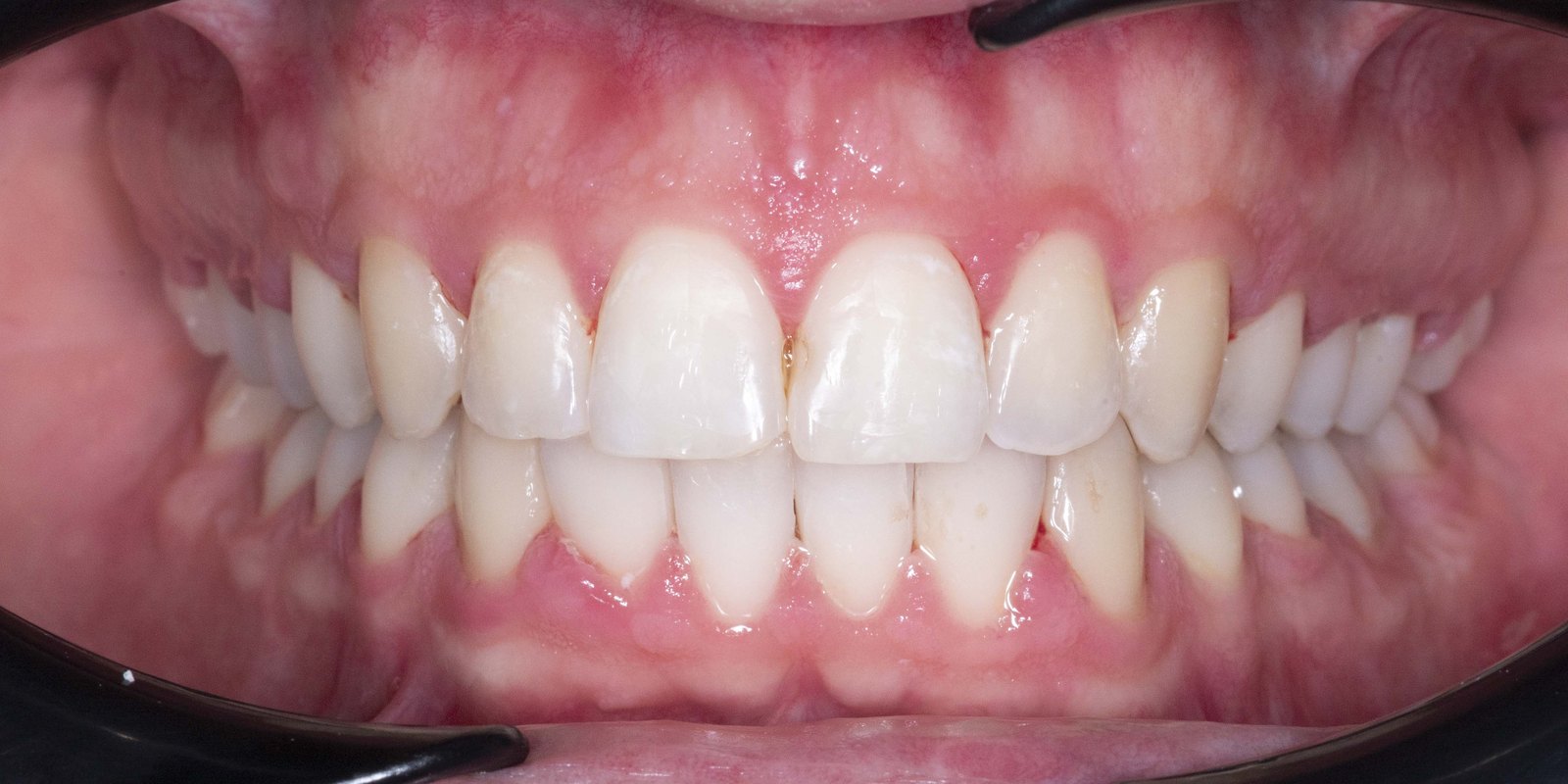 Случай 2, след ортодонтско лечение: фронтален изглед – Saliev Dental Care, София