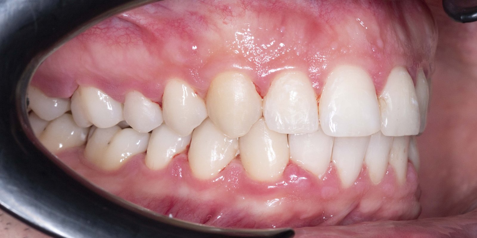 Случай 2, след ортодонтско лечение: страничен изглед, ляво – Saliev Dental Care, София