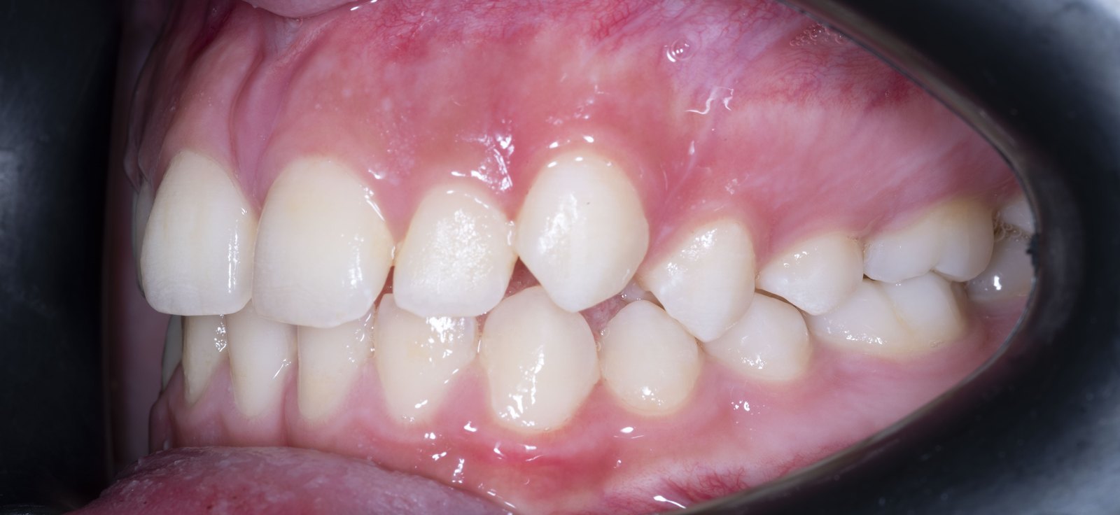 Случай 3, преди ортодонтско лечение: страничен изглед, дясно – Saliev Dental Care, София
