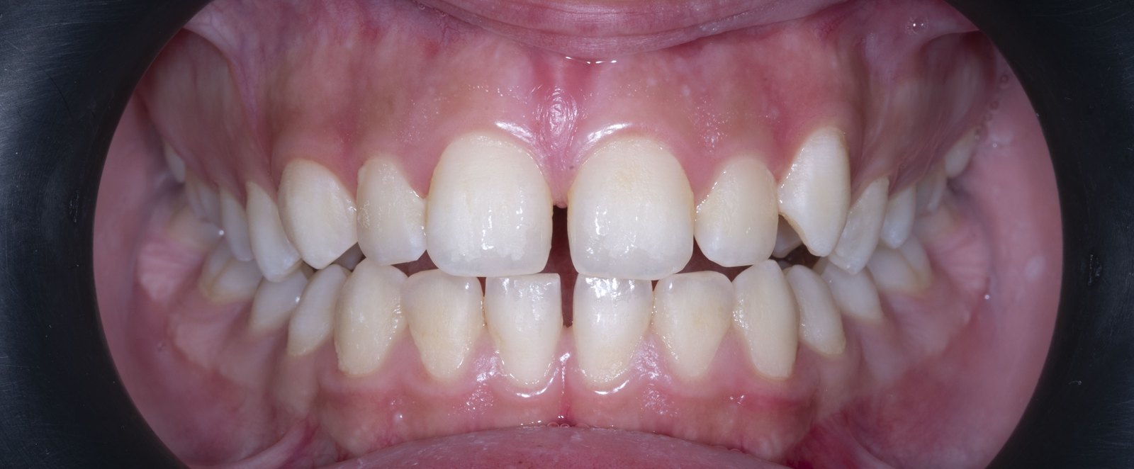 Случай 3, преди ортодонтско лечение: фронтален изглед – Saliev Dental Care, София