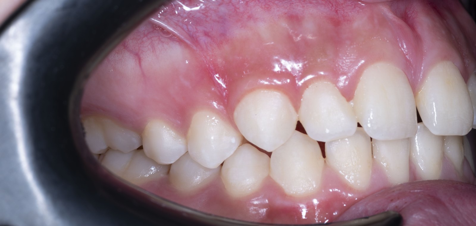 Случай 3, преди ортодонтско лечение: страничен изглед, ляво – Saliev Dental Care, София