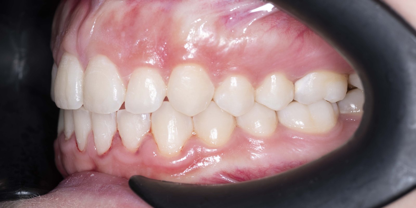 Случай 3, след ортодонтско лечение: страничен изглед, дясно – Saliev Dental Care, София
