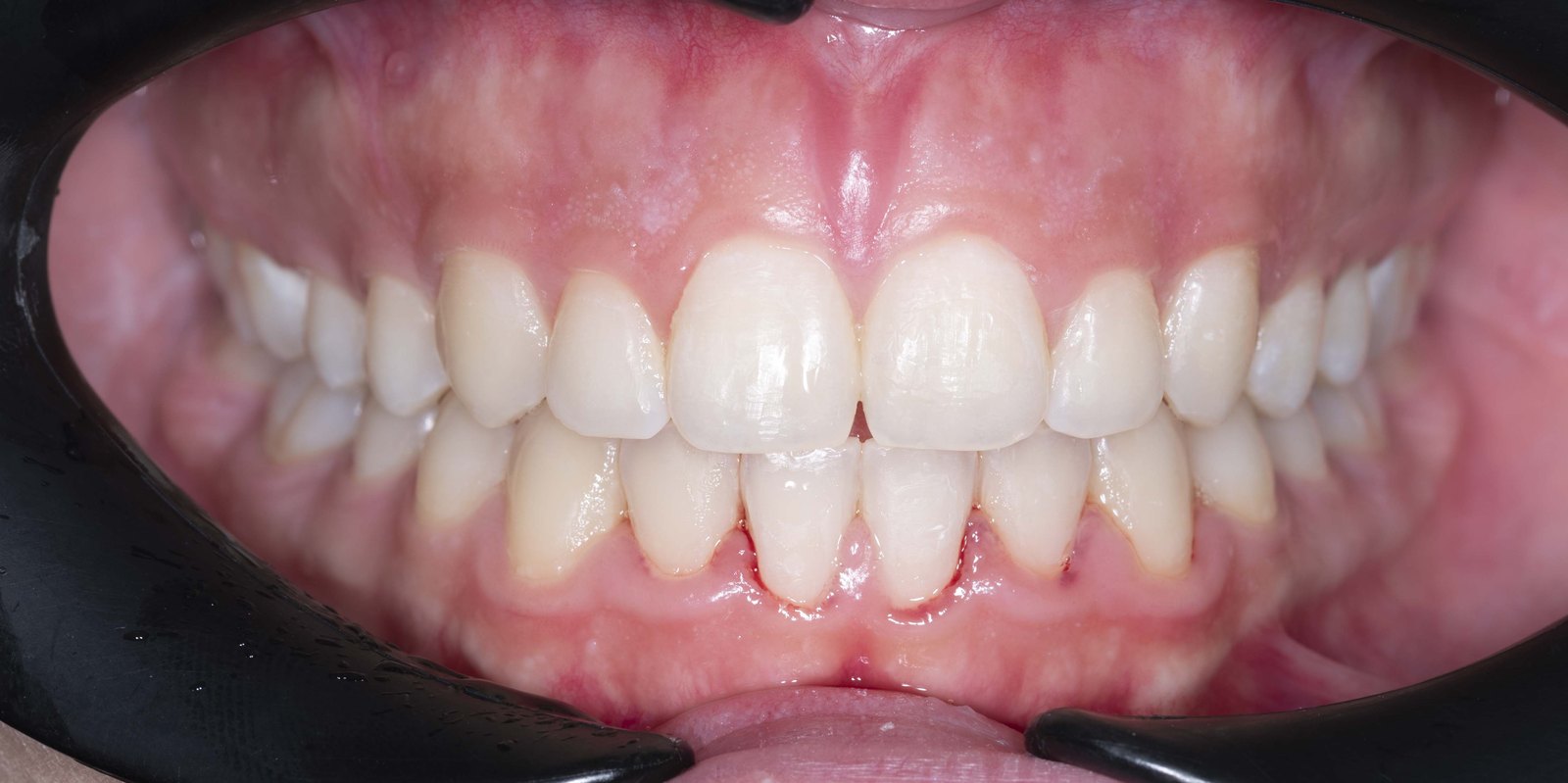 Случай 3, след ортодонтско лечение: фронтален изглед – Saliev Dental Care, София
