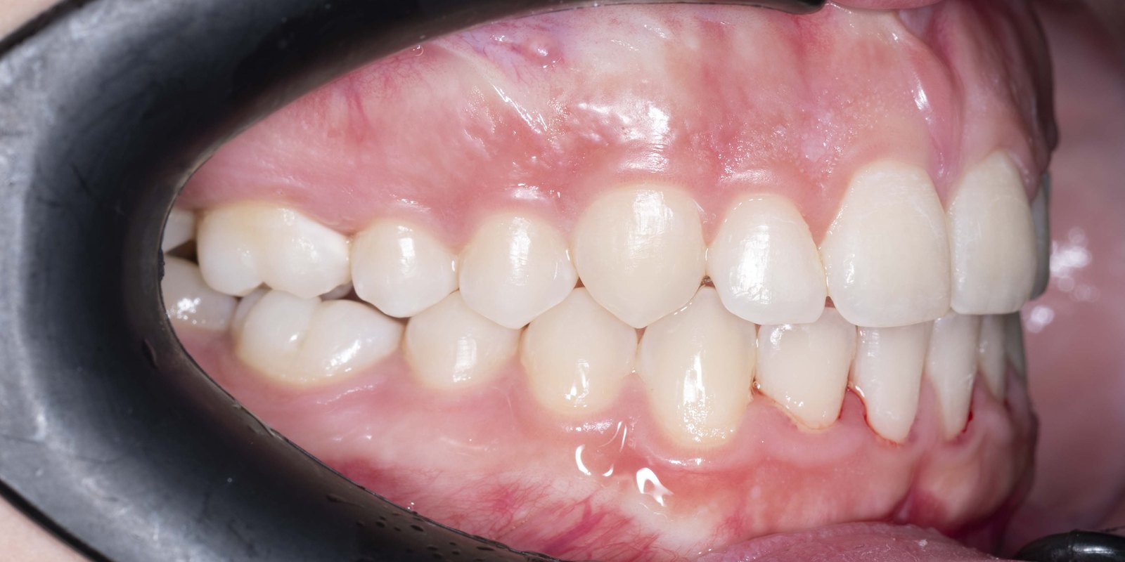 Случай 3, след ортодонтско лечение: страничен изглед, ляво – Saliev Dental Care, София